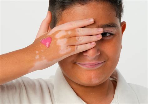 vitiligo fotos|Vitiligo : causes, symptômes, traitements des taches。